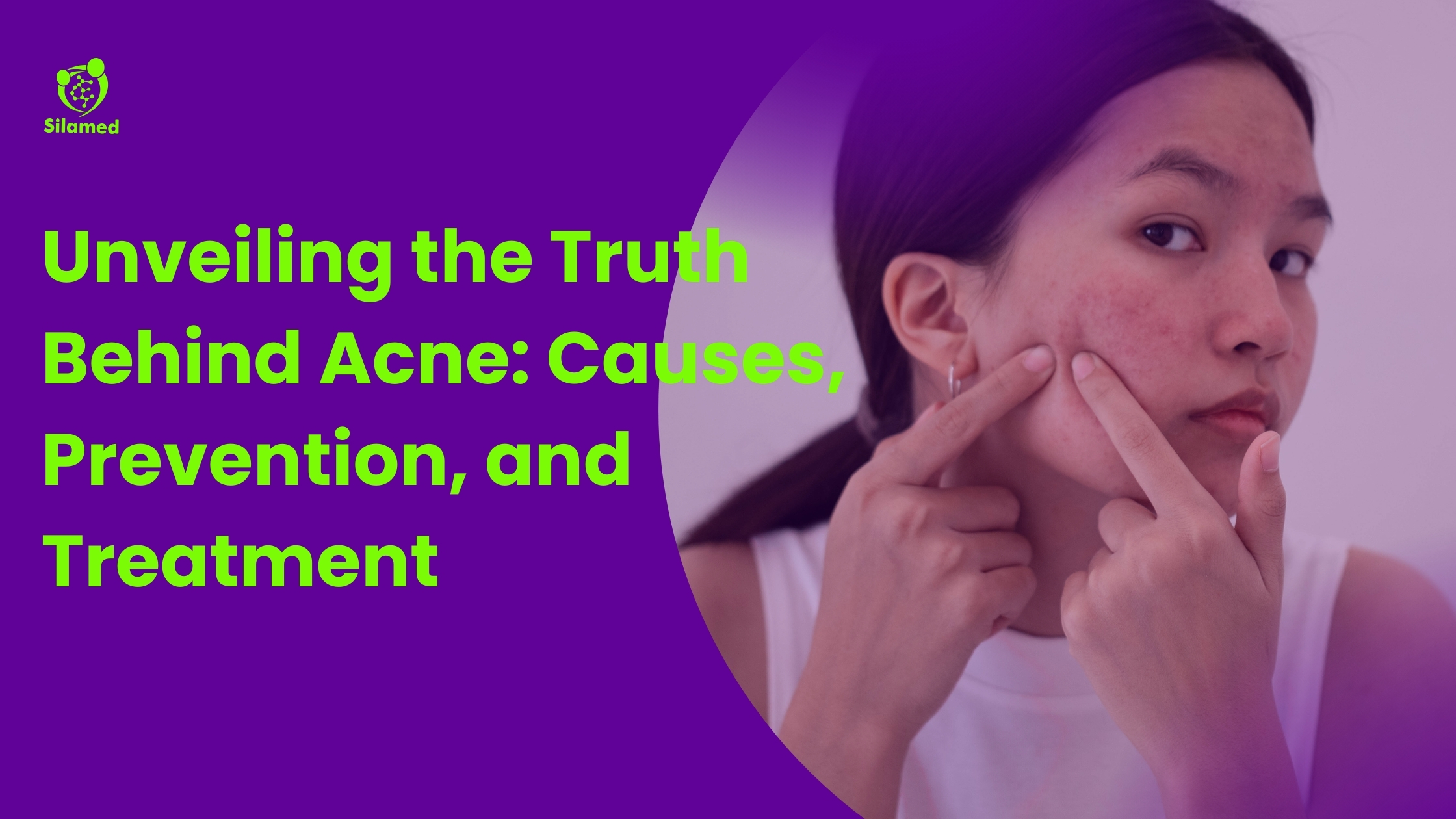 The Acne Guide: Causes, Prevention, and Effective Treatments